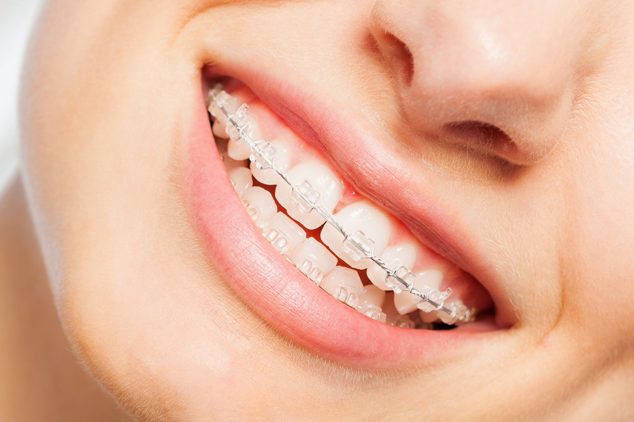 Brackets Estetici